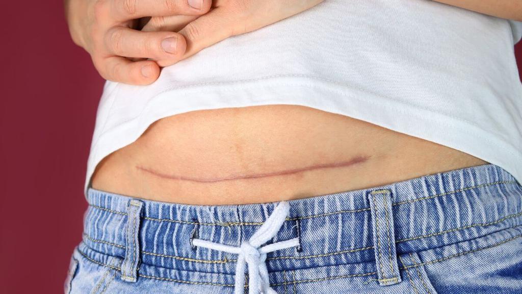what-to-know-about-menopause-after-a-hysterectomy-peanut